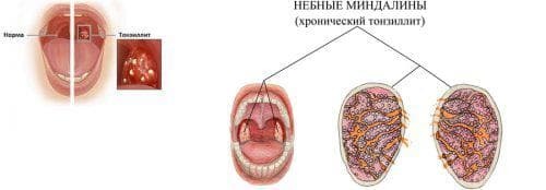 allergische vorm van tonsillitis