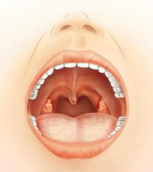 dolor de herpes en la garganta