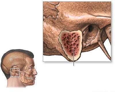 acute mastoïditis