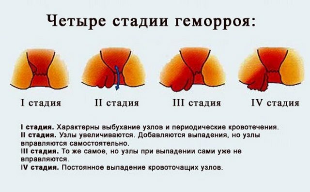 Mengapa tanda-tanda wasir menjadi lebih cerah dengan menstruasi?