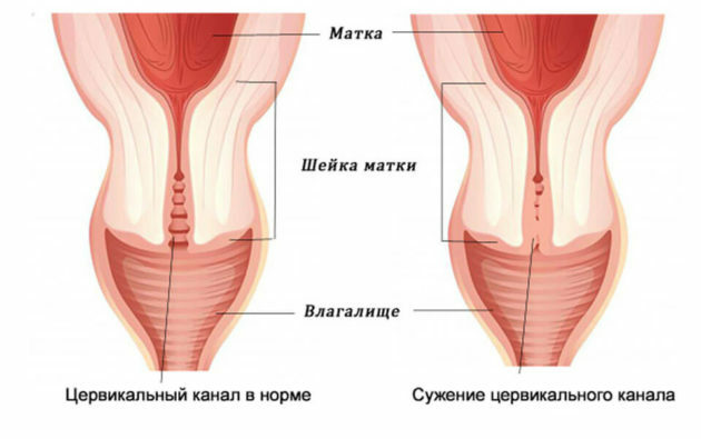 Atrésie cervicale: qu'est-ce que c'est, causes, traitement