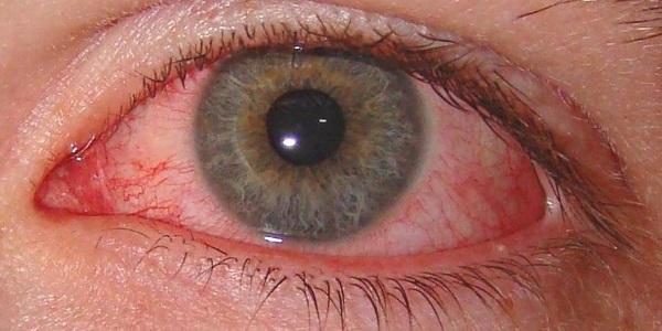 Krom-alergični: kako koristno je zdravilo za oči?