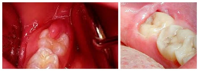 Pericoronaryitis: opções de tratamento e possíveis complicações