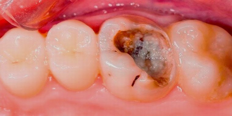 Gangreneuze pulpitis - pulpnecrose in een gevorderd chronisch stadium