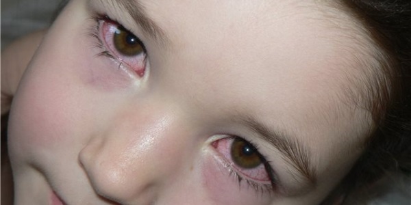 Podrobne o očných kvapkách Okuflesh
