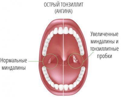 eenvoudige vorm van tonsillitis