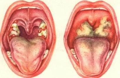 recubrimiento blanco en la garganta en el esquema