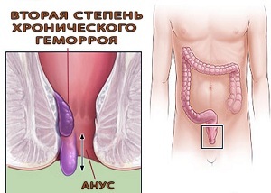 hemorróidas crônicas do 2º grau