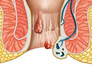 Por que você sente sentimentos desagradáveis ​​no ânus e o que pode ser feito?