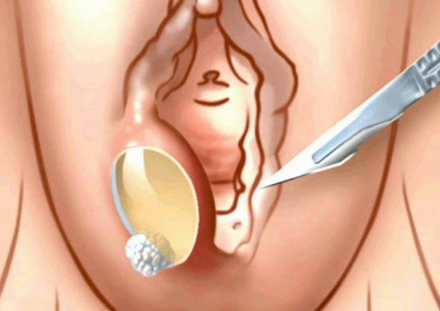 Postpartum perineal ulcer: symptoms, diagnosis, treatment