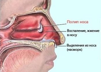 zdravljenje polipov v nosu brez kirurškega posega