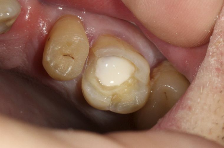 O papel, as técnicas e os estágios de preenchimento da odontologia moderna