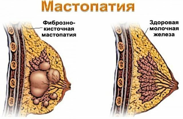 Reasons why a woman can detect colostrum before and during menstruation