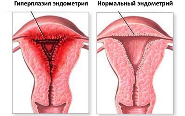 Effective diet with hyperplasia