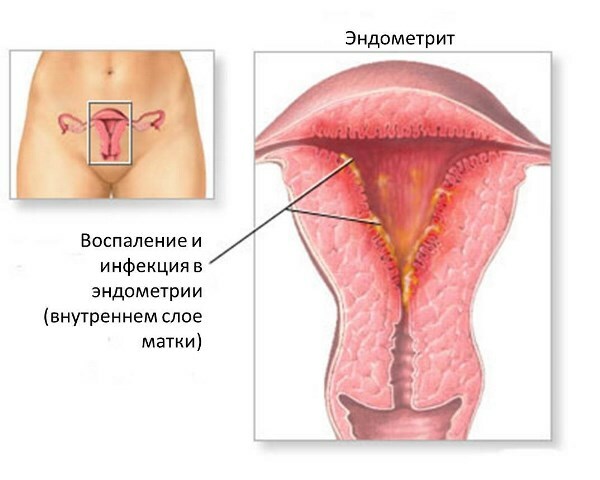 Endometrite: causas, sintomas e tratamento