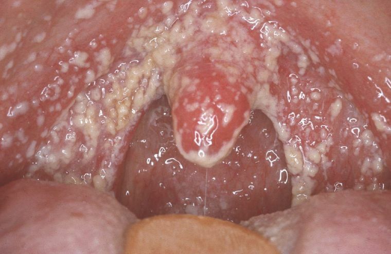 Stomatitis in de keel is een ziekte die geen volwassenen of kinderen spaart