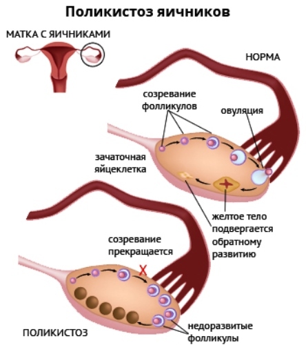 The best herbs in polycystosis