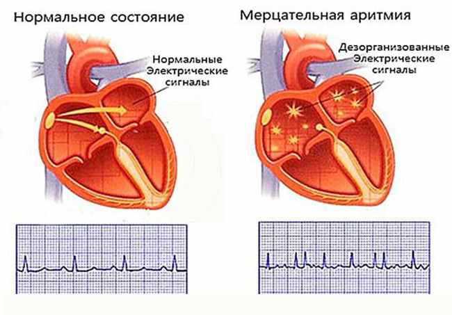 Key reasons why there is arrhythmia with and before menstruation