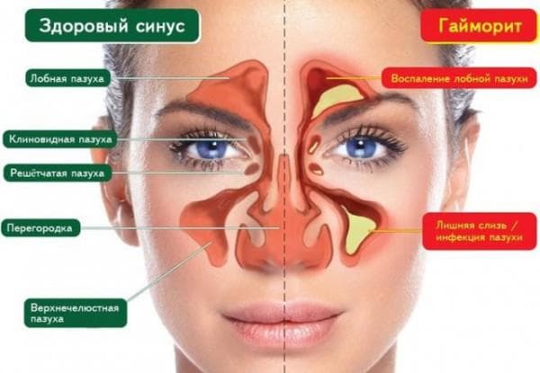 kaip gydyti galvos smegenų sinusą be pertvaros