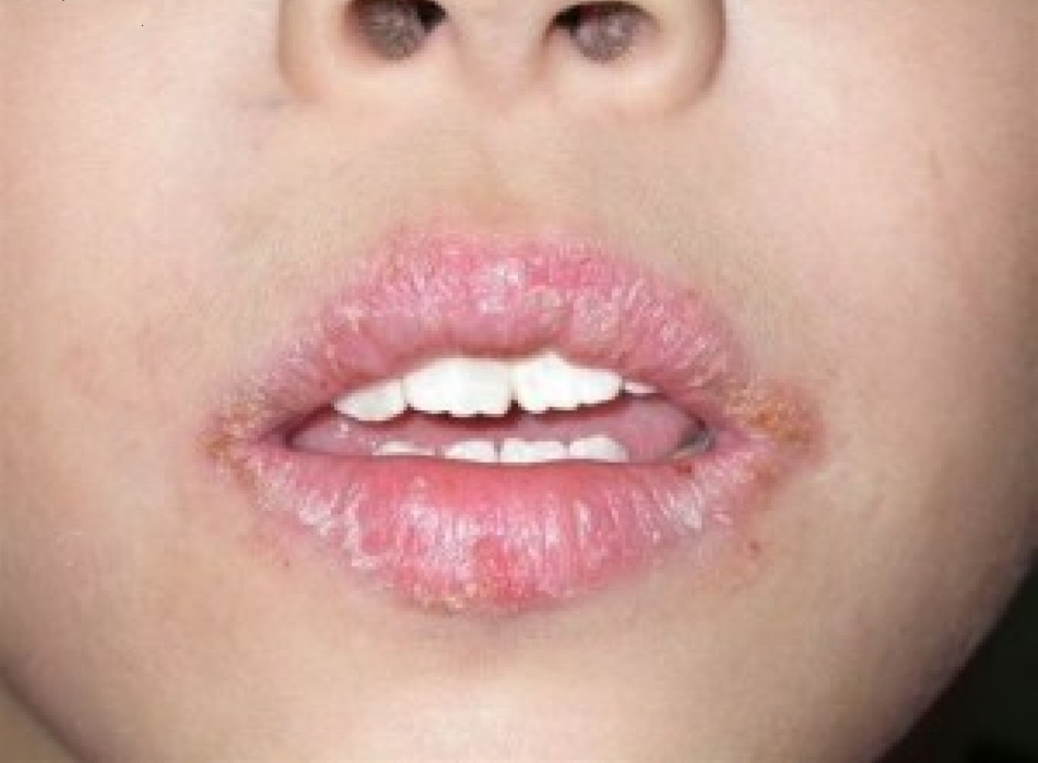 Kodėl lūpose atsiranda įtrūkimai? Kaip gydyti įtrūkimus lūpų kampuose, priepuoliai, cheilitas?
