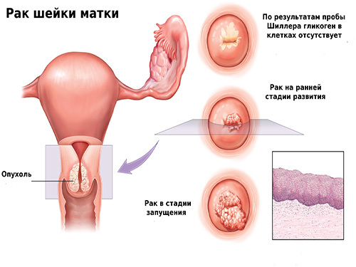 Features of menstruation in cancer of the uterus and ovaries