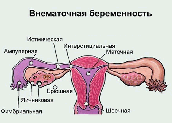 Perbedaan pendarahan dari menstruasi selama kehamilan