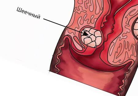 Livmoderhalsgraviditet: vad är, symtom, kliniska riktlinjer
