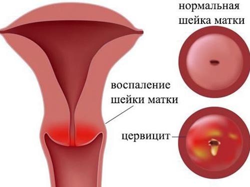 Causas da expansão do canal cervical em mulheres pós-menopáusicas