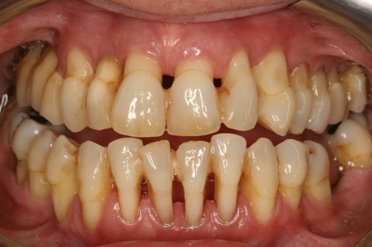 Gejala, pengobatan dan konsekuensi dari periodontitis umum