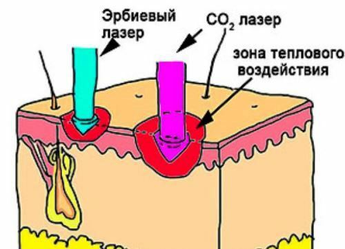 How to use the laser in gynecology