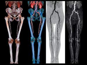 הפרת זרימת הגפיים התחתונות: סימפטומים וטיפול