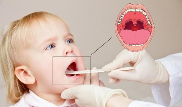 Acute tonsillitis symptomen en behandeling bij kinderen