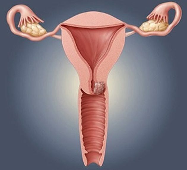 Kraurosis av vulva: symtom, orsaker, behandling, foton, recensioner
