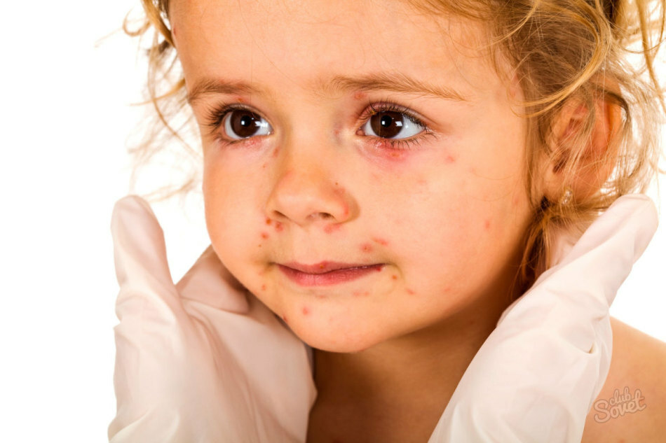 Wat is klierziekte bij volwassenen en kinderen achter de oren: symptomen, tekenen, oorzaken, behandeling. Hoe scrofula te behandelen bij volwassenen en baby's?