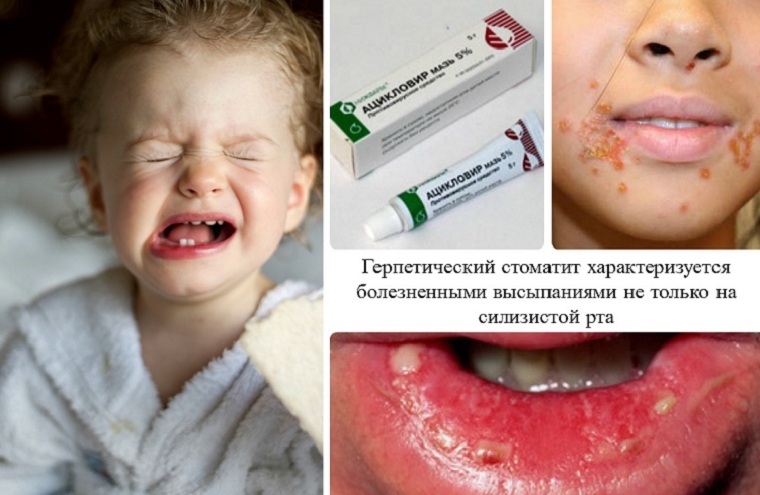 Herpetic stomatitis in children: causes, symptoms and treatment