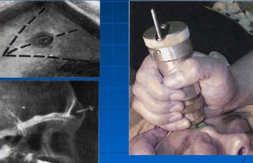 frontal sinus puncture