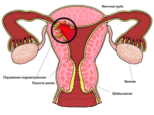 Adenomyosis: the code of the disease according to μb 10