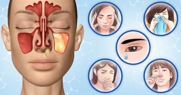 chronische odontogene sinusitis