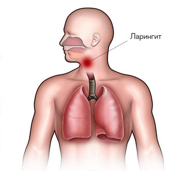 Pharyngitis, laryngitis, tracheitis