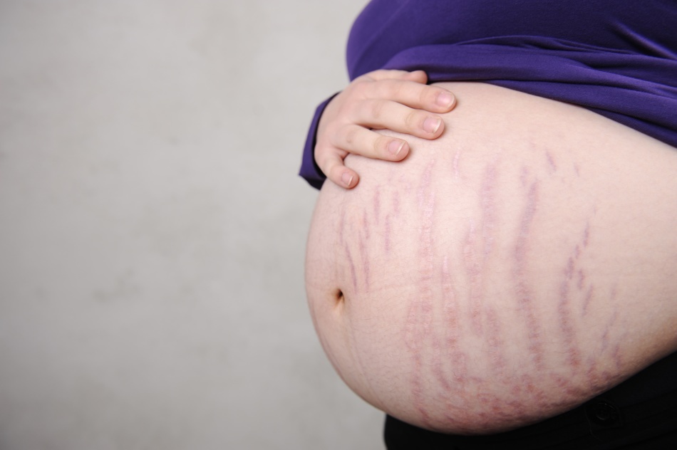 Stretch marks durante a gravidez: como evitá-los? Como evitar estrias durante a gravidez?