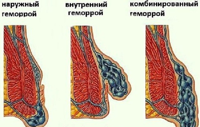 išorinis ir vidinis hemorojus