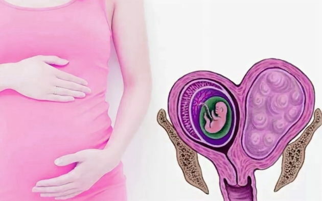 Er det mulig å bli gravid og føde med myomer i livmoren