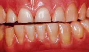 teeth with bruxism
