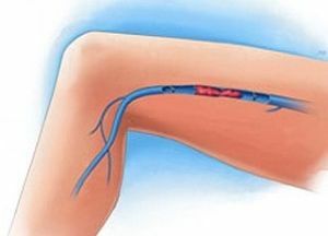 trombose das extremidades inferiores