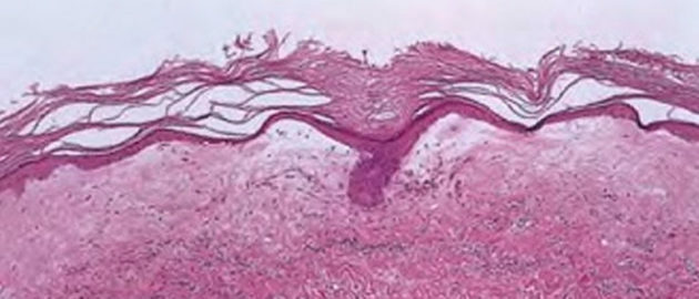 Kraurosis der Vulva: Symptome, Ursachen, Behandlung, Fotos, Bewertungen
