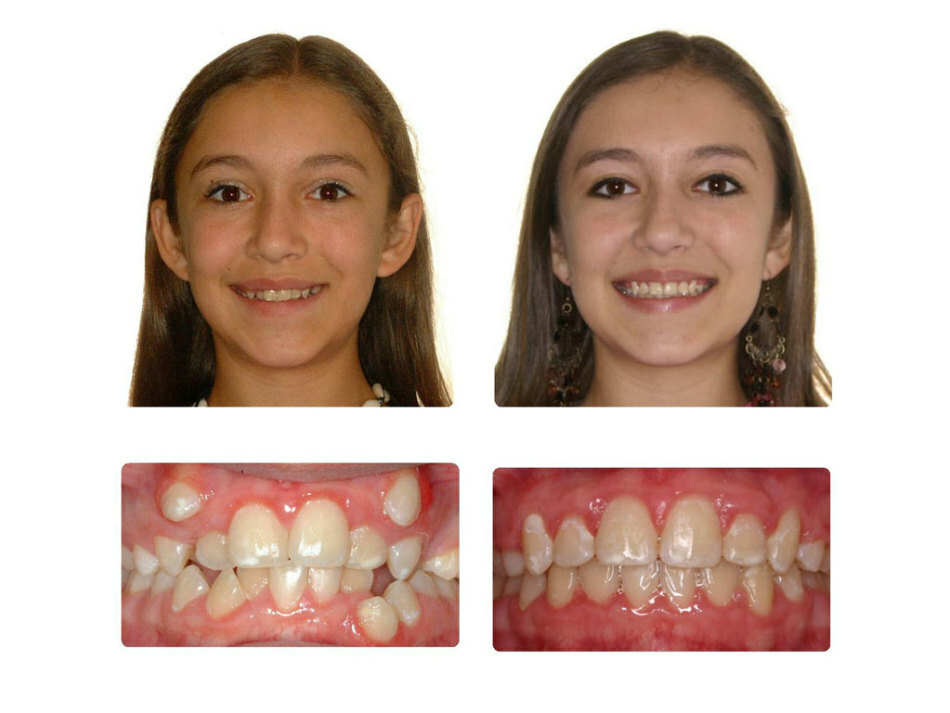 Nesprávný skus u dospělých. Jak sladit zuby? Zarovnání zubů se zarážkami, kappa: fotografie před a po. Korekce kousnutí bez příchytků