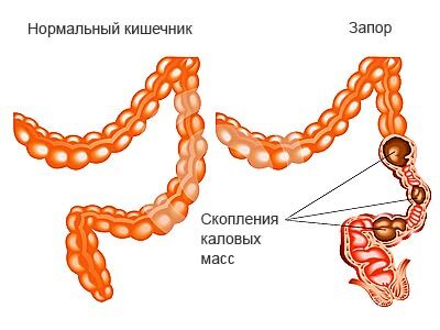 Why there is constipation before menstruation and how to get rid of it?