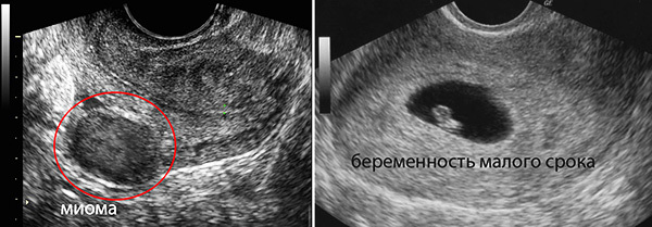 Miomas podem ser confundidos com gravidez