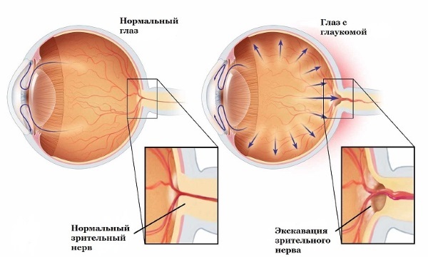 Okumed - drops from glaucoma