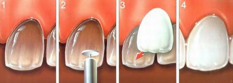 Bagaimana pemasangan veneer pada gigi dan perawatan lebih lanjut?